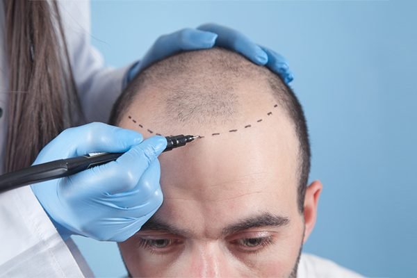 Transplantasi Rambut