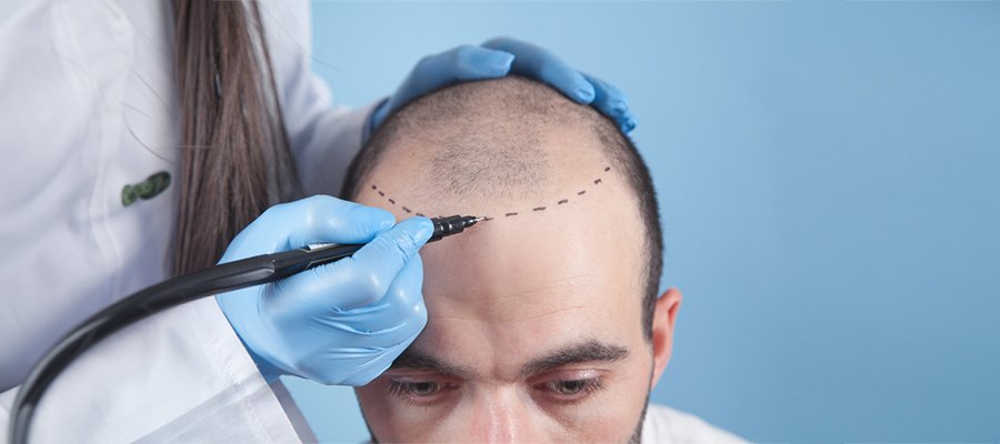Transplantasi Rambut